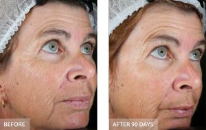 Side-by-side images of a woman's face before and after 90 days reveal the transformative effects of Ultraceuticals, with noticeably reduced wrinkles and improved skin texture. | Josephine's Salons and Spas