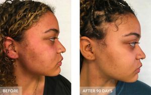 Side-by-side images reveal a person's face before and after 90 days, showcasing reduced redness and improved skin texture with the help of Ultraceuticals. | Josephine's Salons and Spas