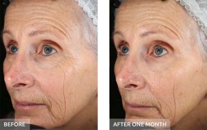 Experience the transformative power of Ultraceuticals with before and after images of an elderly woman. Witness the remarkable reduction in facial wrinkles after just one month, showcasing the incredible effectiveness of this skincare solution. | Josephine's Salons and Spas